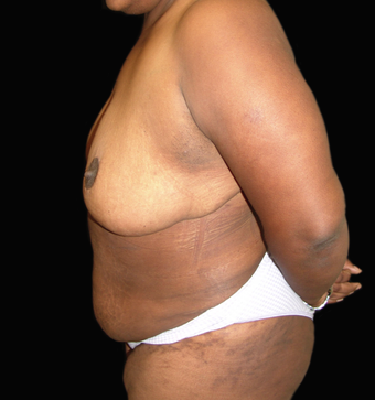 Tummy Liposuction