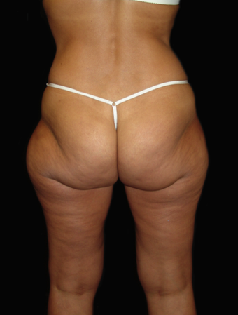 Hip Liposuction