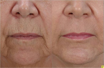 Fractional Resurfacing