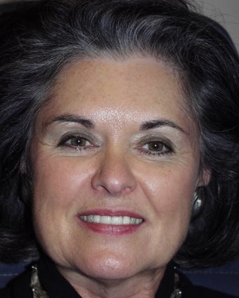 Botox injection to the glabella