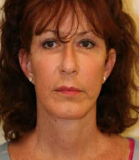 Face and Necklift, Eyelids, Temporal Browlift