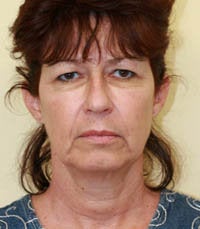 Face and Necklift, Eyelids, Temporal Browlift