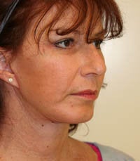 Face and Necklift, Eyelids, Temporal Browlift