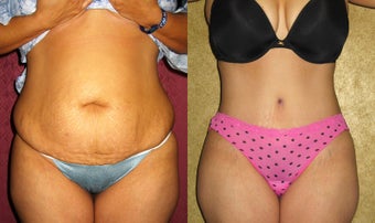 tummy tuck