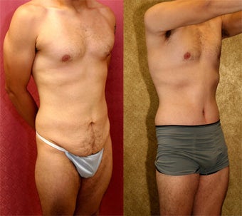 tummy tuck