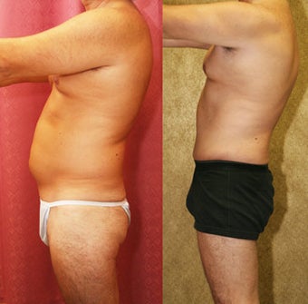 Male abdominoplasty or tummy tuck