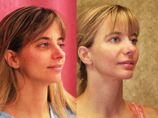 facial fat grafting