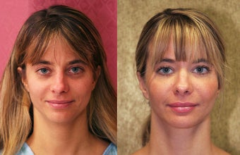 facial fat grafting
