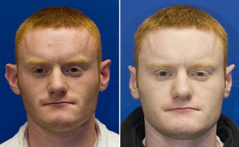 Otoplasty