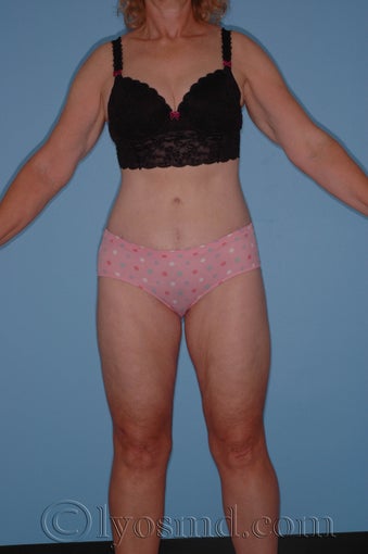 Lower Body Lift with Tumescent Liposuction