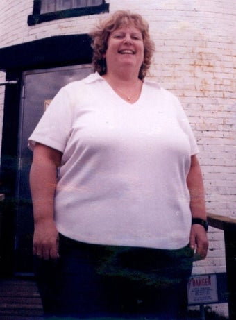 Gastric Bypass