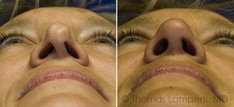 Revision Rhinoplasty with ear cartilage grafting