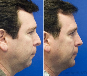 Rhinoplasty, Sliding Genioplasty, Neck liposuction