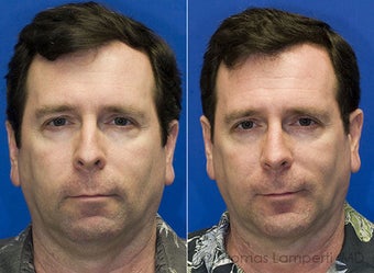 Rhinoplasty, Sliding Genioplasty, Neck liposuction