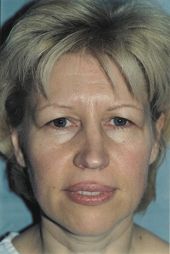 Browlift
