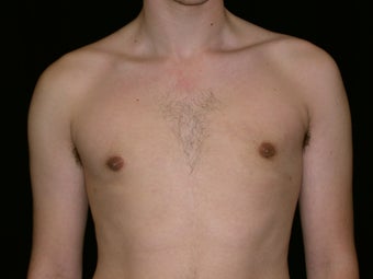 Gynecomastia Reduction Surgery