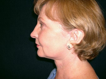 Necklift