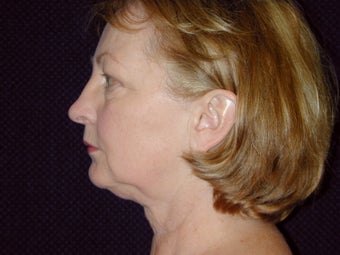 Necklift