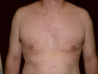 Gynecomastia Reduction Surgery