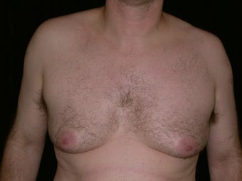 Gynecomastia Reduction Surgery