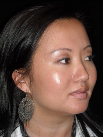 Lip augmentation with Juvederm