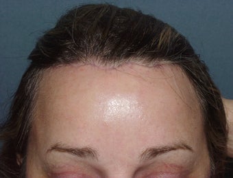 Browlift/forehead reduction at 2 weeks