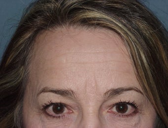 Browlift/forehead reduction at 2 weeks