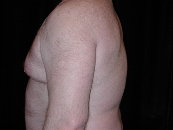 Cool Lipo