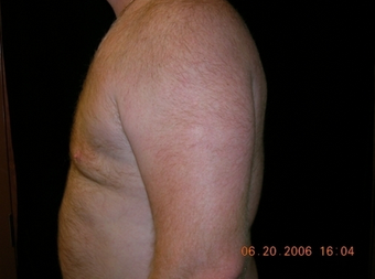 Cool Lipo