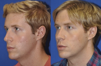 Endonasal Rhinoplasty