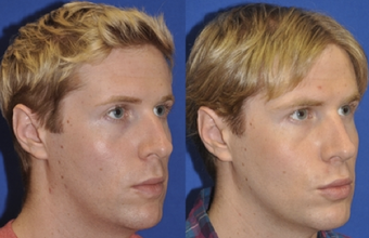 Endonasal Rhinoplasty