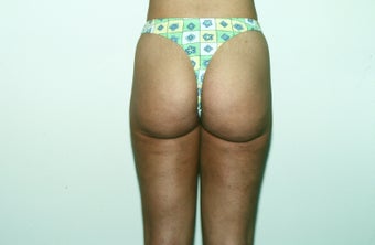 Liposuction