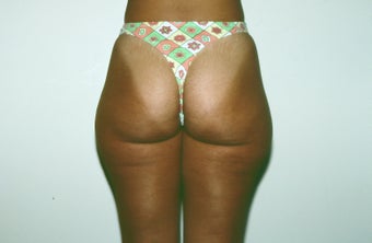 Liposuction
