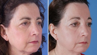 Endoscopic Browlift and Upper and Lower Eyelid Surgery