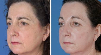 Endoscopic Browlift and Upper and Lower Eyelid Surgery