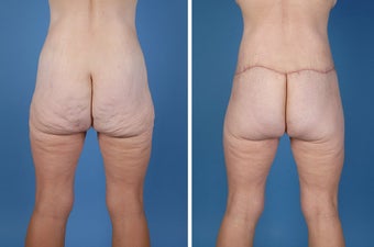Flank Excision