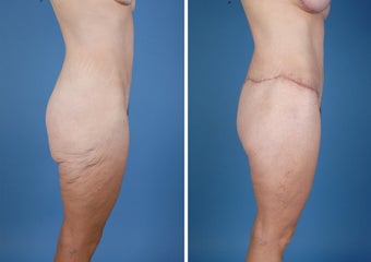 Flank Excision