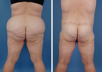 Bilateral Lower Body Lift and Liposuction
