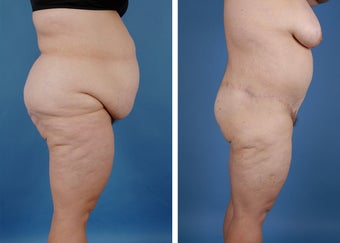 Bilateral Lower Body Lift and Liposuction