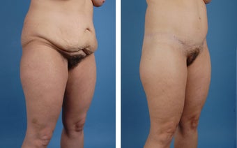 Lower Body Lift and Liposuction of Lateral Thighs