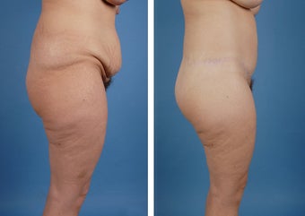 Lower Body Lift and Liposuction of Lateral Thighs