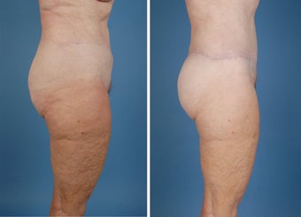 Flank Excision, Abdominoplasty Scar Revision, Liposuction of the Back