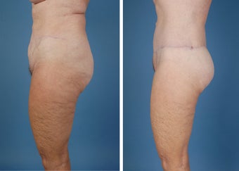 Flank Excision, Abdominoplasty Scar Revision, Liposuction of the Back