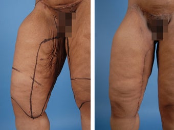 Thighplasty