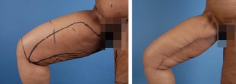 Thighplasty