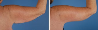 Arm Lift (Brachioplasty)