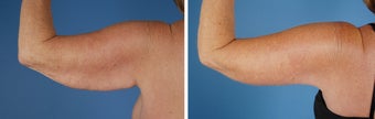 Arm Lift (Brachioplasty)