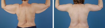 Arm lift (Brachioplasty)