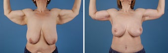 Arm lift (Brachioplasty)
