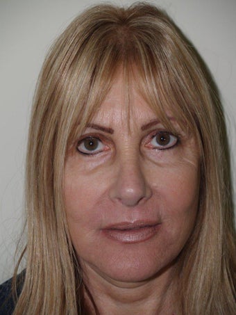 Revision Rhinoplasty